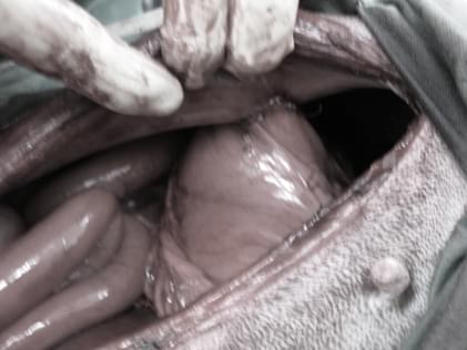 腹壁に胃の一部を固定した写真